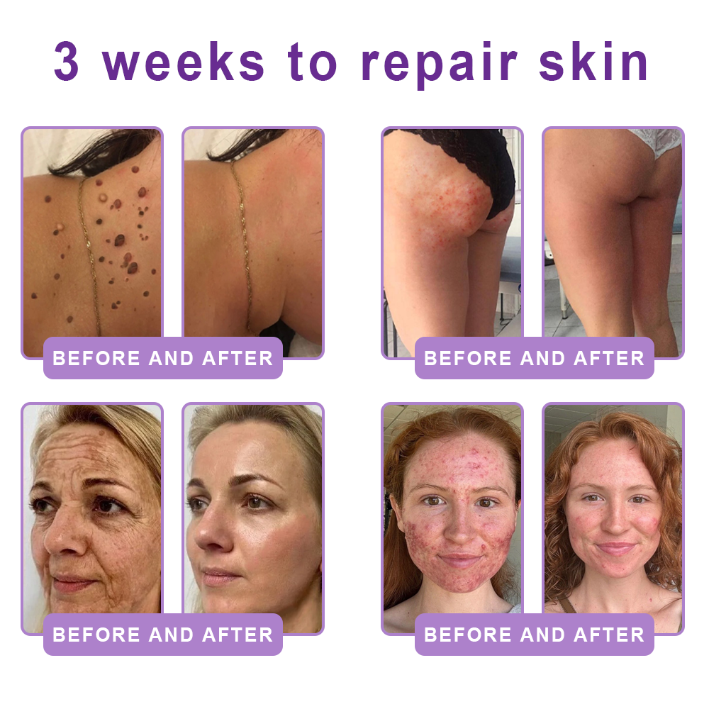 ca Canada Compliant : HISKIN® PDRN Multi-Peptide Massaging Body Roller Cream- Anti-aging, Hydrating, Skin Firming & Lifting, Skin Repair, Even Tone, Acne and Dark Spot Treatment, Wart and Mole Removal, and Psoriasis Relief.