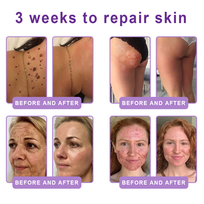 ca Canada Compliant : HISKIN® PDRN Multi-Peptide Massaging Body Roller Cream- Anti-aging, Hydrating, Skin Firming & Lifting, Skin Repair, Even Tone, Acne and Dark Spot Treatment, Wart and Mole Removal, and Psoriasis Relief.