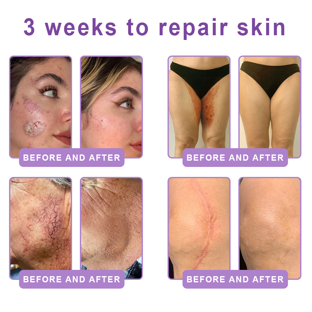 ca Canada Compliant : HISKIN® PDRN Multi-Peptide Massaging Body Roller Cream- Anti-aging, Hydrating, Skin Firming & Lifting, Skin Repair, Even Tone, Acne and Dark Spot Treatment, Wart and Mole Removal, and Psoriasis Relief.
