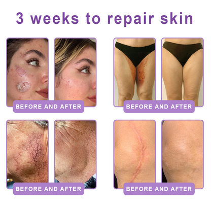 ca Canada Compliant : HISKIN® PDRN Multi-Peptide Massaging Body Roller Cream- Anti-aging, Hydrating, Skin Firming & Lifting, Skin Repair, Even Tone, Acne and Dark Spot Treatment, Wart and Mole Removal, and Psoriasis Relief.