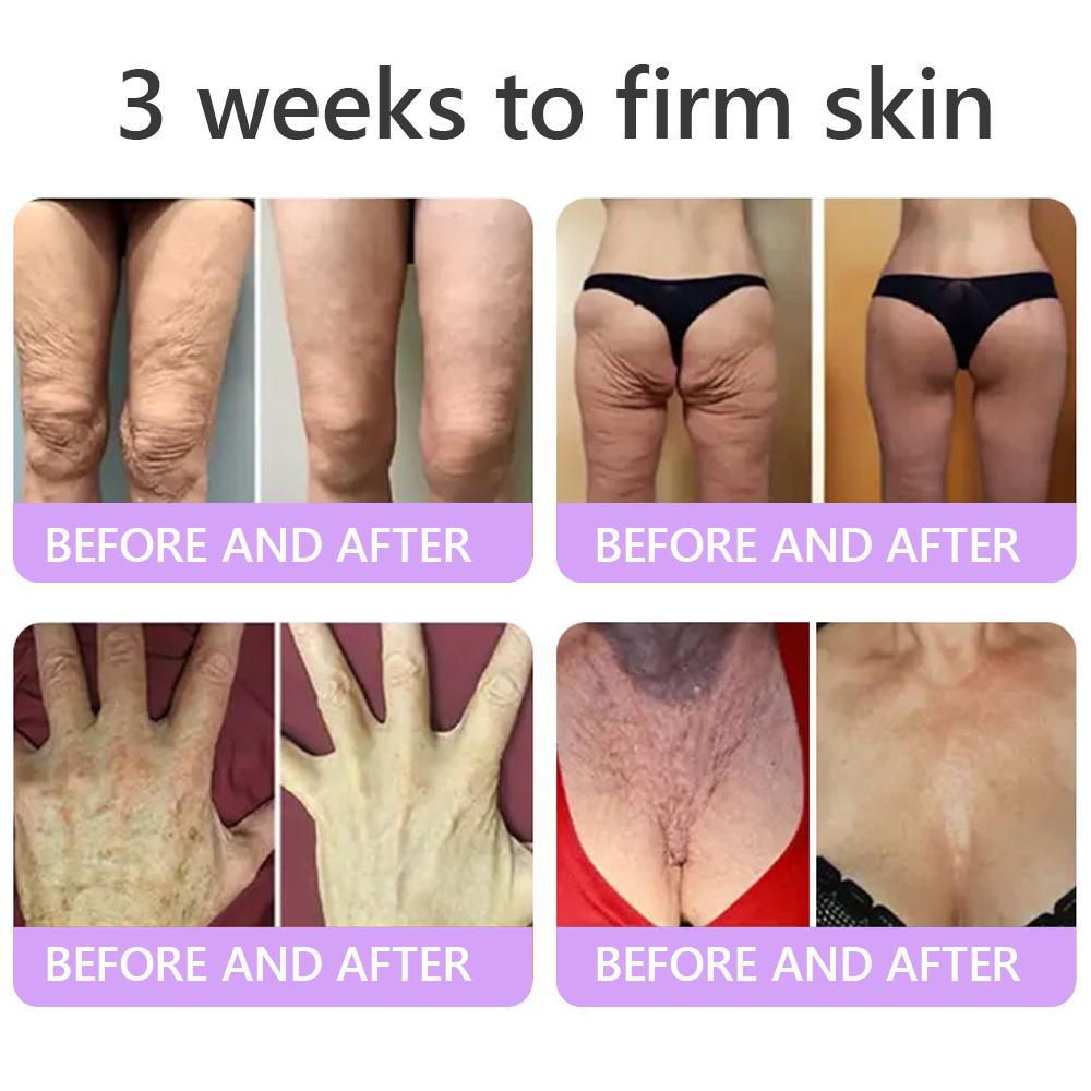 ca Canada Compliant : HISKIN® PDRN Multi-Peptide Massaging Body Roller Cream- Anti-aging, Hydrating, Skin Firming & Lifting, Skin Repair, Even Tone, Acne and Dark Spot Treatment, Wart and Mole Removal, and Psoriasis Relief.