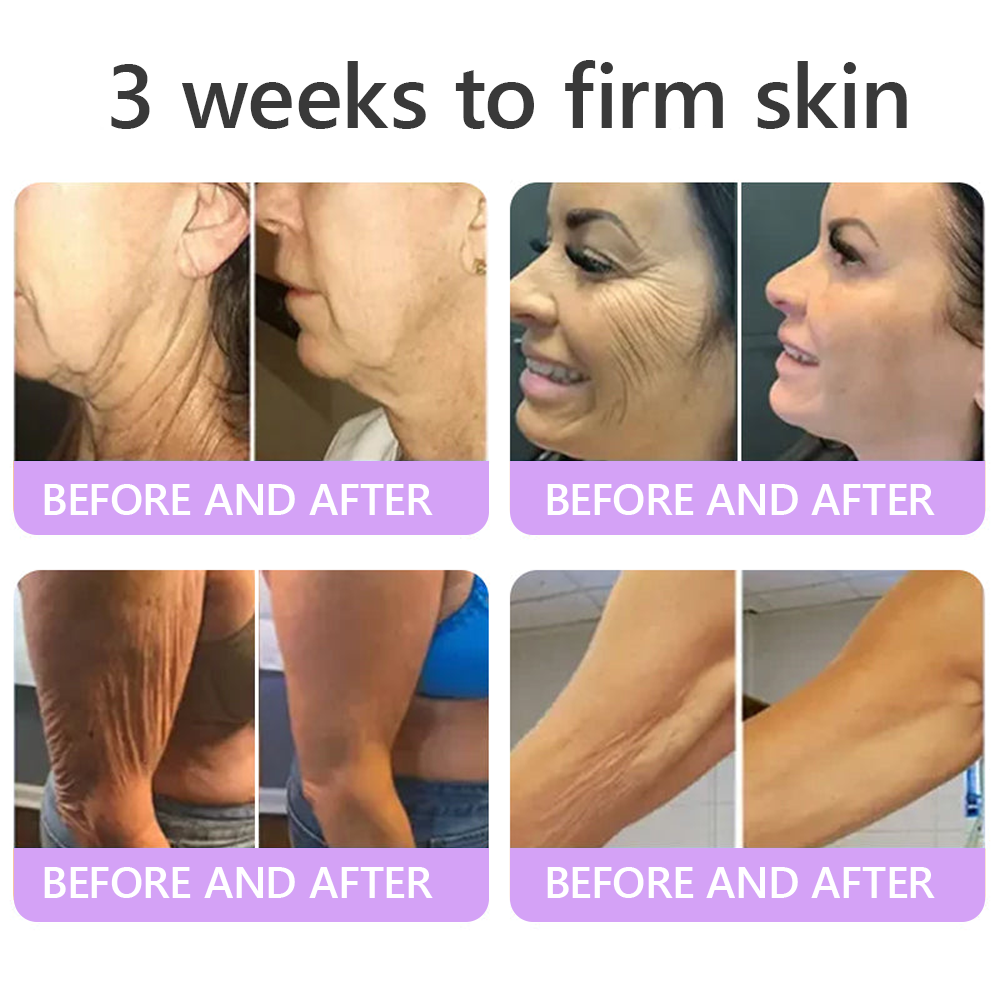 ca Canada Compliant : HISKIN® PDRN Multi-Peptide Massaging Body Roller Cream- Anti-aging, Hydrating, Skin Firming & Lifting, Skin Repair, Even Tone, Acne and Dark Spot Treatment, Wart and Mole Removal, and Psoriasis Relief.