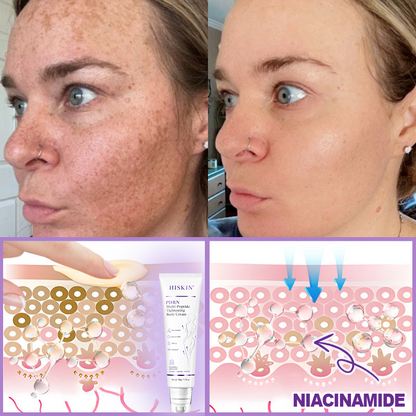ca Canada Compliant : HISKIN® PDRN Multi-Peptide Massaging Body Roller Cream- Anti-aging, Hydrating, Skin Firming & Lifting, Skin Repair, Even Tone, Acne and Dark Spot Treatment, Wart and Mole Removal, and Psoriasis Relief.